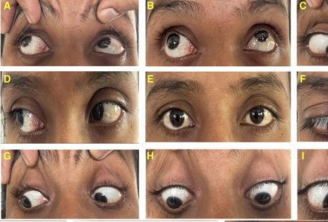 Physical Examination – Skew Gaze